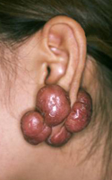 ケロイド症例(耳）