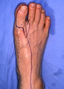 切断指再建術（移植部位の左足親指）