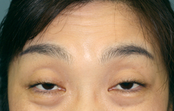 腱膜性眼瞼下垂症　術前