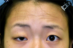 先天性眼瞼下垂症(術前）