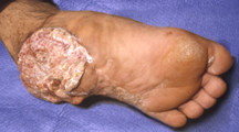 皮膚がん症例2