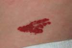 イチゴ状血管腫（赤アザ）の写真