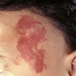 単純性血管腫(赤アザ）の写真