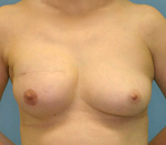 乳房インプラント症例４